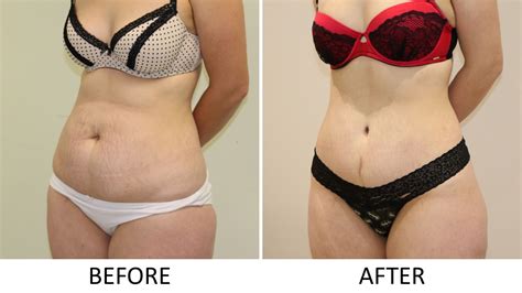 Tummy Tuck (Abdominoplasty) - The Karri Clinic