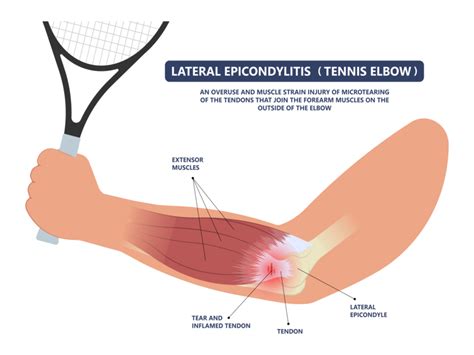 Elbow Sprain