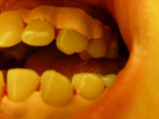 Gingivitis Gum Disease