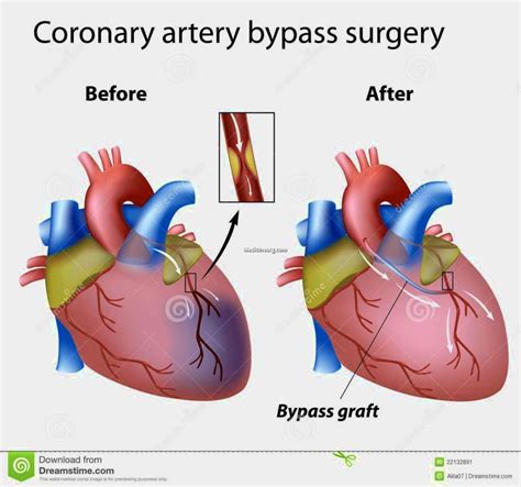 Heart Bypass Surgery | MedicineBTG.com