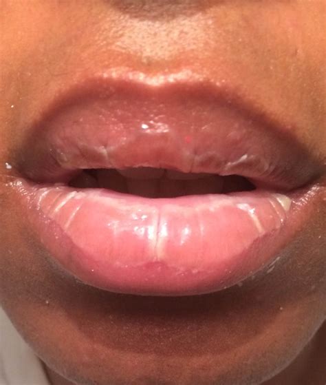 Yeast Infection Cause Chapped Lips | Lipstutorial.org