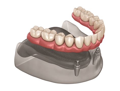 Snap On Dentures | Burns Dentistry