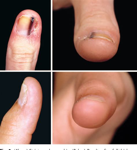 Albums 103+ Pictures Photos Of Toe Nail Melanoma Updated