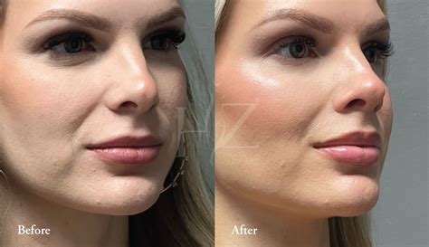 Upper Lip Lift Before & After — HZ Plastic Surgery