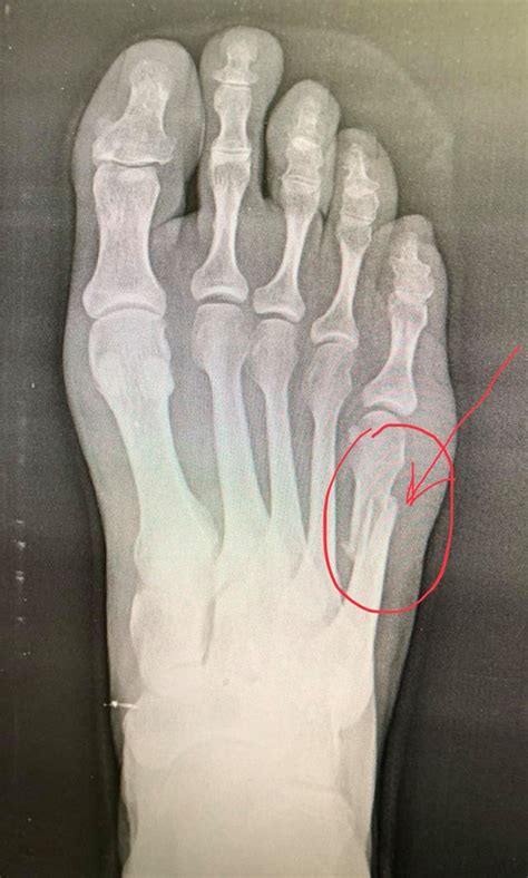 Fifth Metatarsal Fracture - Orthopaedic Specialists of Louisville