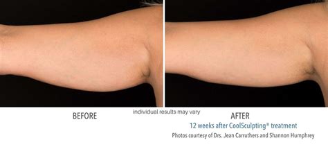 CoolSculpting before and after results from real patients - SCULPTDTLA.COM