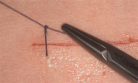 Simple Interrupted Suture | UpSurgeOn