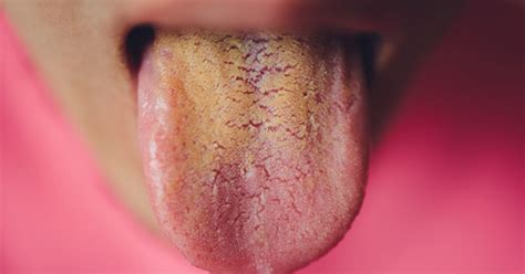 Yellow Tongue: Causes, Symptoms, Treatment, Diagnosis and Prevention