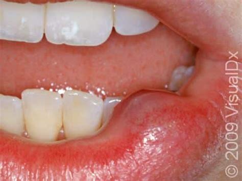 Oral Mucocele Condition, Treatments and Pictures for Adults - Skinsight