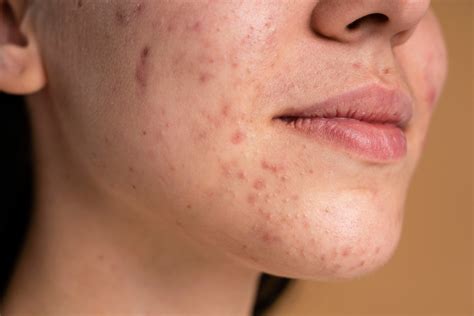 Skin purging or just acne? 4 ways to tell the difference!