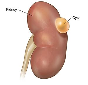 Kidney Cyst Symptoms And Treatment Options - Ask The Nurse Expert