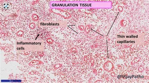 TISSUE REPAIR: By Connective tissue deposition. Angiogenesis & Tissue remodeling - Pathology ...