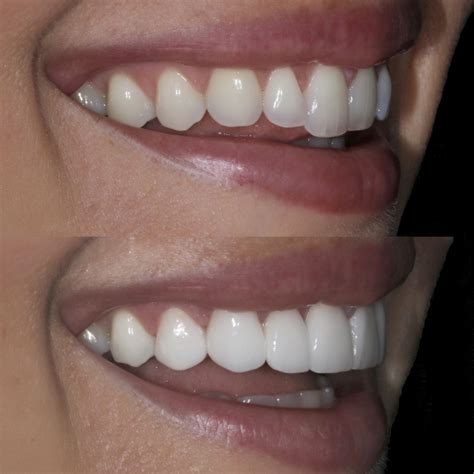 fashion jackson before after porcelain veneers dr scott harris dental Teeth Bonding, Dental ...