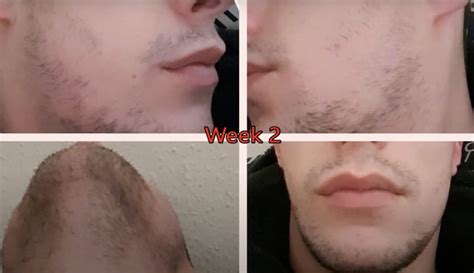 Minoxidil Beard Growth: Before & After, Usage, Side Effects