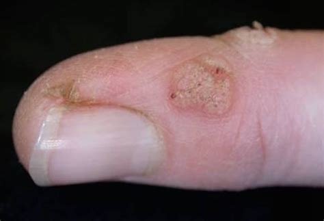 Health Check: do home remedies for common warts really work?