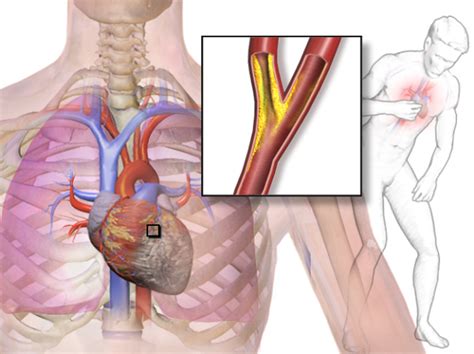 Stable and Unstable Angina Pectoris — Symptoms and Diagnosis