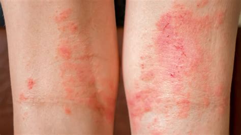 Seborrheic Dermatitis According to the NHS: Causes & Treatments