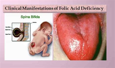 Vitamin B9 (Folic acid) - www.medicoapps.org