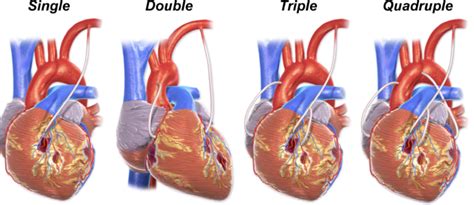 What Is A Coronary Artery Bypass Graft? Learn More Online