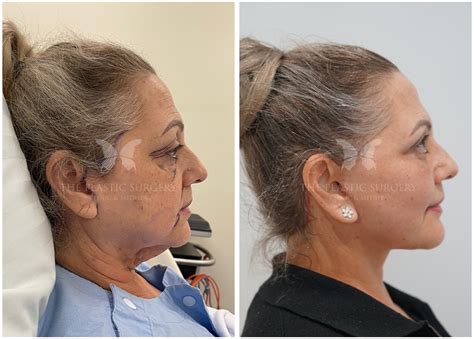 Facial Fat Grafting Gallery | The Plastic Surgery Clinic