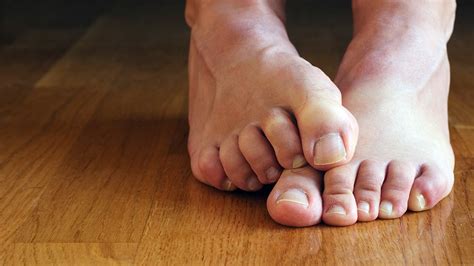 Claw Toes Could Be a Symptom of Causal Diabetes or Neurological Problem: Doctors