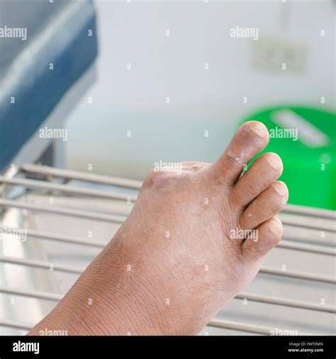 Blister on the toe of diabetic patient Stock Photo - Alamy