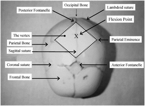 The bones, sutures and fontanelles of the fetal skull, illustrating the vertex (shaded area) and ...