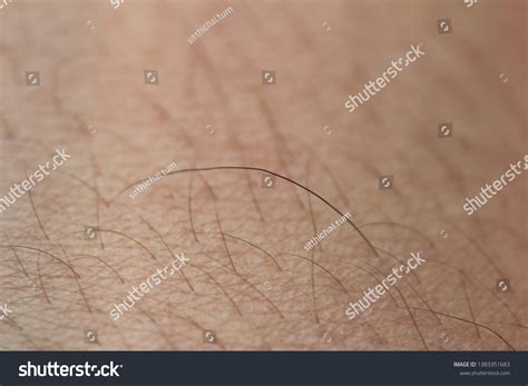 Hairs That Abnormal On Human Body Stock Photo 1383351683 | Shutterstock