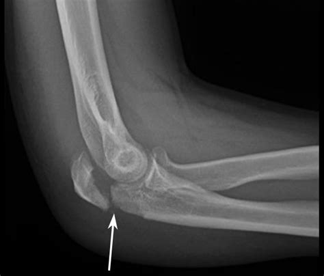 Elbow fracture in iran - Jam Hospital in Tehran - irantreatments