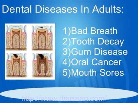 5 dental diseases in adults