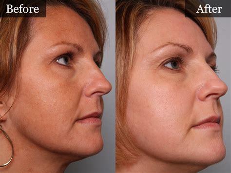 Microdermabrasion and Chemical Peels - The Vein Center