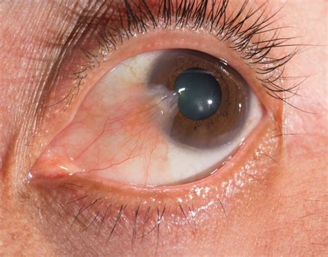 What is a pinguecula? What is a pterygium? - Mark C. Vital, M.D.