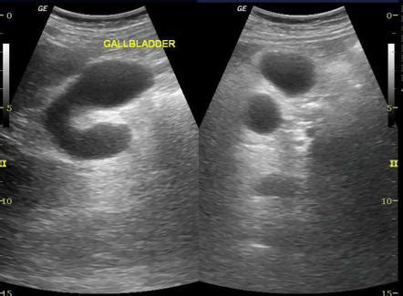 Gallbladder duplication | Radiology Reference Article | Radiopaedia.org