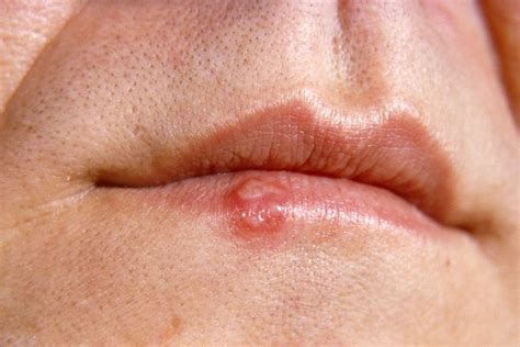 Herpes Around Lips Symptoms | Lipstutorial.org