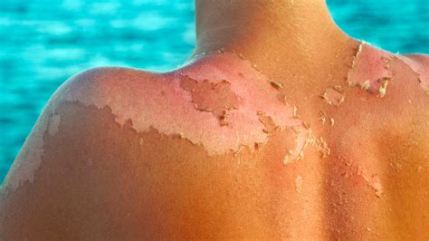 Why Sunburn Peeling Is Both a Good and Bad Thing for Your Skin | Allure