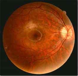 Blue Cone Monochromacy - Retinal Disease - Mobile Health Knowledge