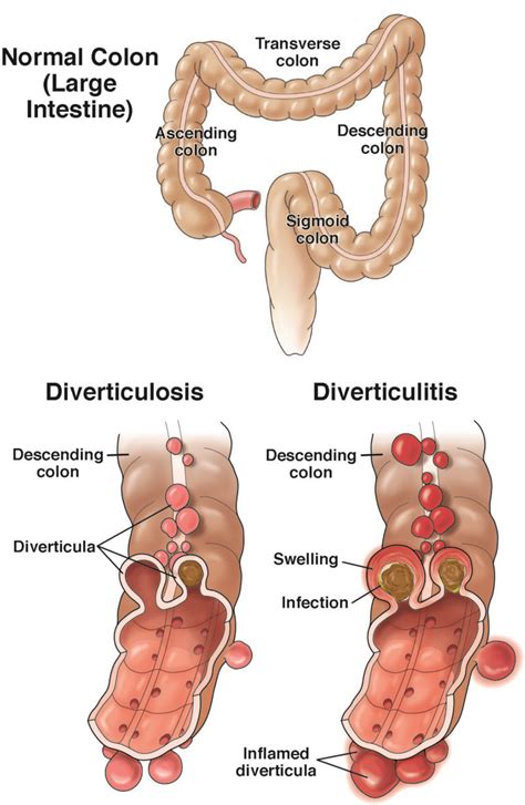 Diverticulitis - AGA GI Patient Center