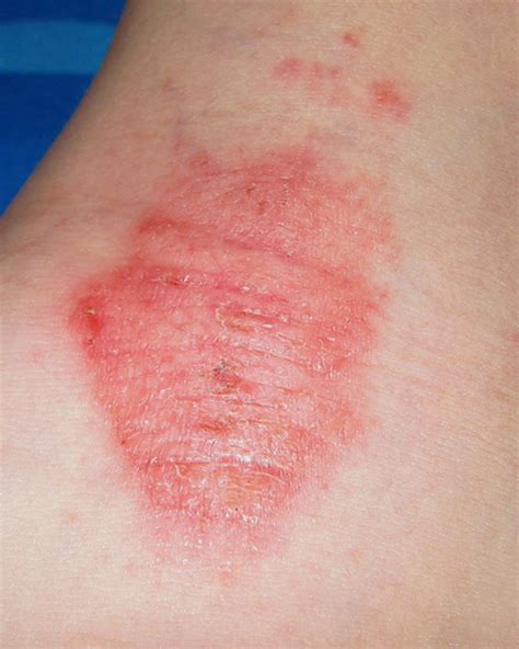 Eczema. Treatments, Help, Advice and Pictures for Mild to Extreme Cases. | HubPages