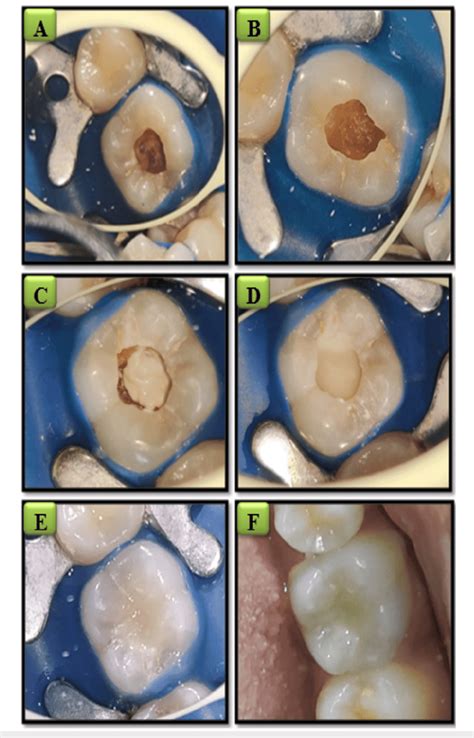 Clinical procedure for indirect pulp capping. (A) Rubber dam isolation... | Download Scientific ...