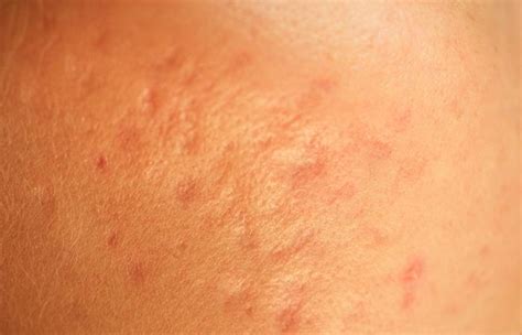 How To Remove Chickenpox Scars From The Skin