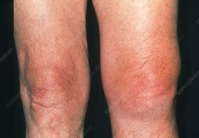 Inflamed knee of an elderly man affected by gout - Stock Image - M165 ...