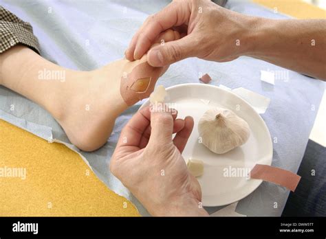 Plantar wart treatment Stock Photo - Alamy