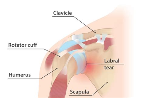 Shoulder Labral Tear - Range Physiotherapy