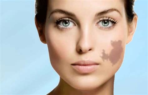 Birthmark Removal – Easy Ways to get rid of Birthmarks at home (With images) | Birthmark ...