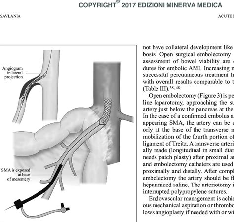 -hybrid treatment of sMa origin lesion (open sMa exposure and ...