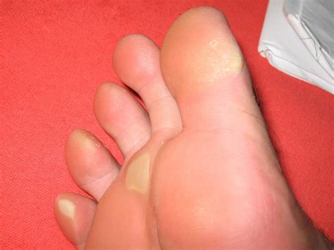 Yellow feet: 6 potential causes