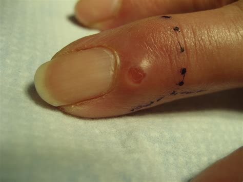 Photos of Mucous Cysts in Fingers - John Erickson, MD