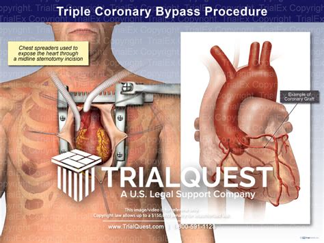 Triple Bypass Procedure - TrialExhibits Inc.