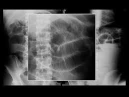 Radiologist Human: valvulae conniventes