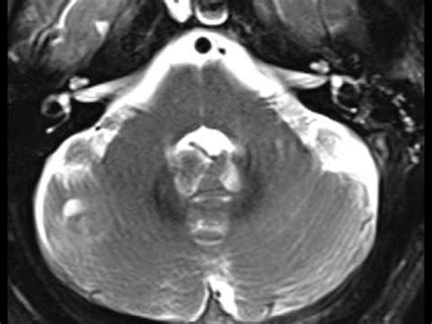 Capillary Telangiectasia - YouTube